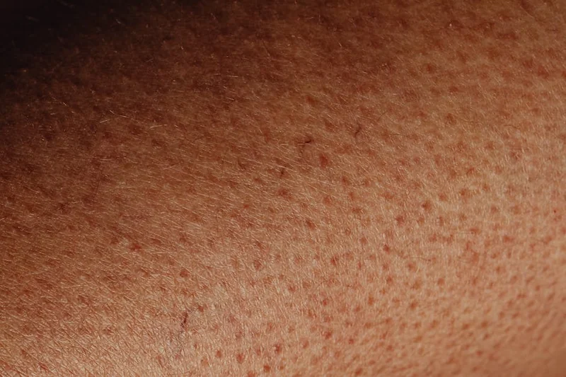 표피낭종 제거 수술
